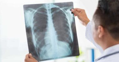 أسباب الالتهاب الرئوى الحاد.. اعرف علاماته المبكرة وعوامل الخطر