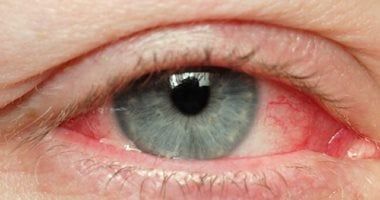 أنواع التهاب ملتحمة العين وطرق الوقاية والعلاج