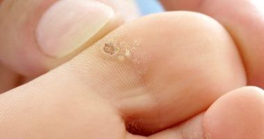 جفاف القدمين وتغيير الجوارب يوميا يحمى من الإصابة بـ"عين السمكة"