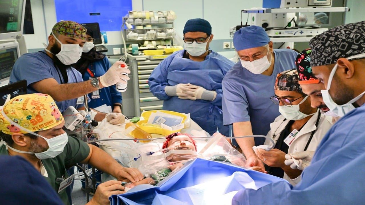 بدء عملية فصل التوأم الملتصق السعودي.. صور