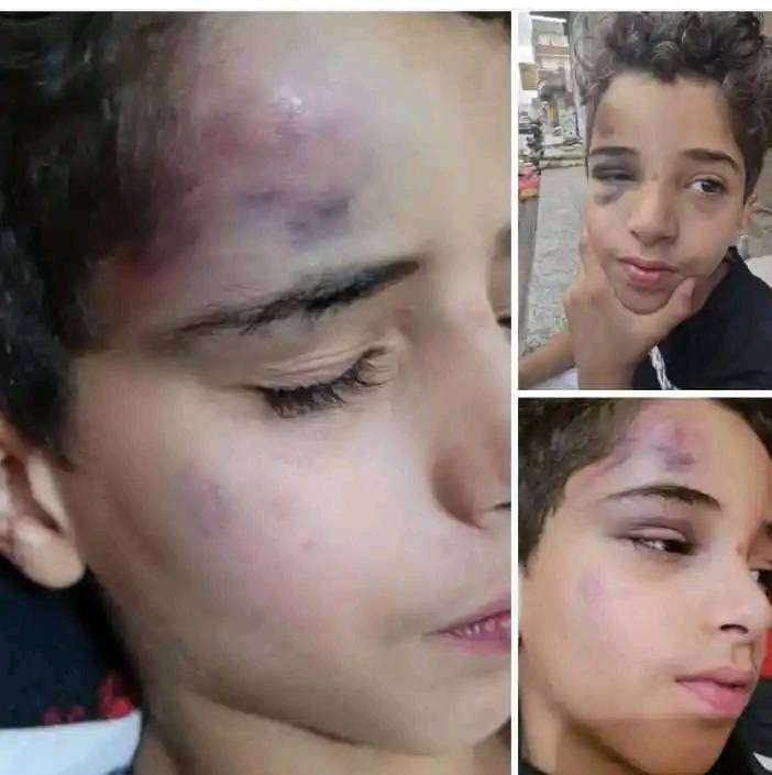 طفل يُضرب بوحشية بعد تسليمه مفتاح سيارة عثر عليه! (صورة مؤلمة)