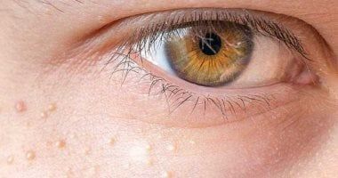 ومضات وتهيج و مشاكل فى الرؤية.. علامات وأعراض عن سرطان العين