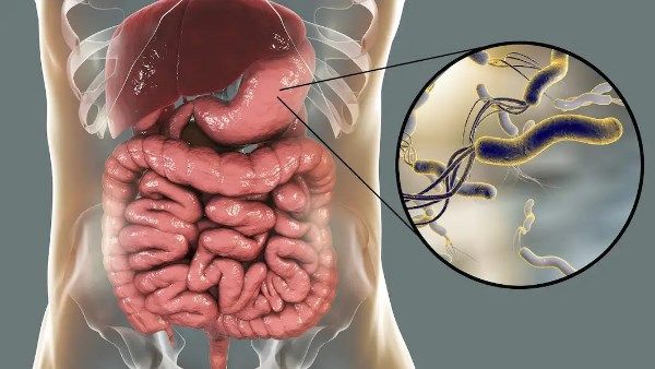 انتبه للأعراض...كيف تعرف أنك مصاب بجرثومة المعدة؟