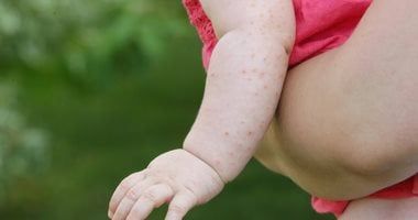 لماذا يصيب حمو النيل الصغار.. طرق العلاج والوقاية؟