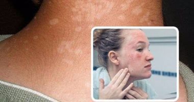 متلازمة الجلد المحروق.. اعرف معناها وإزاى تتعامل معها