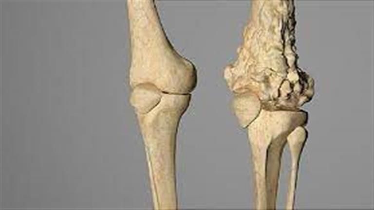 علامة "غريبة" ظهرت على شابة كشفت إصابتها بسرطان العظام- لن تتوقعها