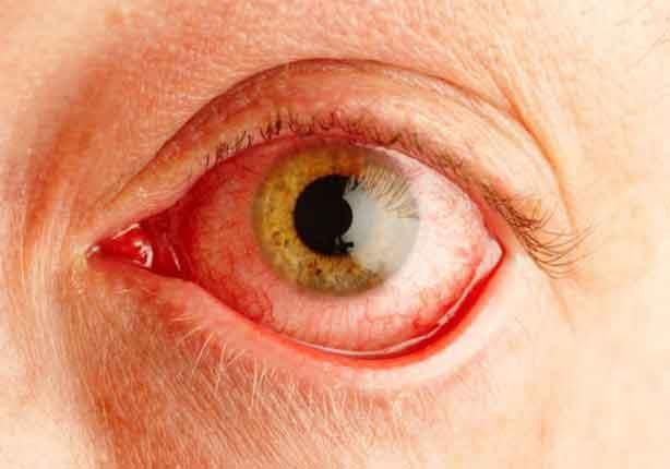 5 مشكلات صحية خطيرة يشير إليها احمرار العين