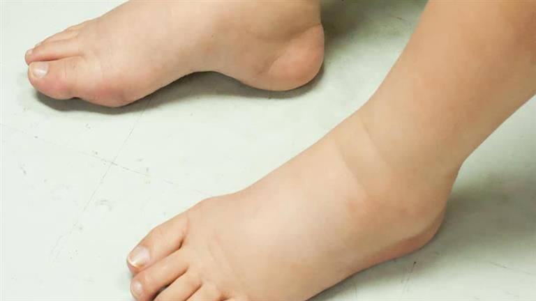 ما أسباب وأعراض الوذمة؟
