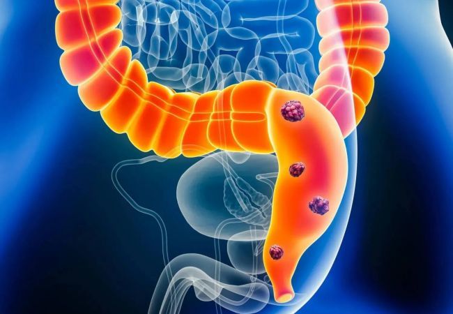 للقولون «حاسة سادسة»... كيف يمكن أن تؤدي إلى فقدان الوزن؟