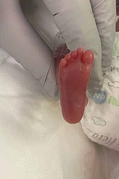 مولود أد الصابونة.. طفل مبتسر يدخل موسوعة جينيس فى عيد ميلاده الأول "فيديو"