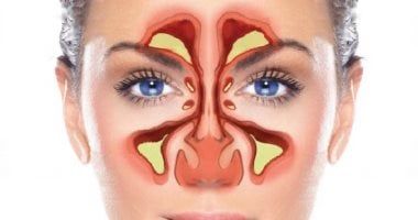 أورام تظهر بأعراض مشابهة لالتهاب الجيوب الأنفية المزمن.. اعرف أنواعها