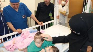 لمدة 9 ساعات | بدء عملية فصل التوأم السيامي السوري “سيلين وإيلين” في مستشفى عبد الله التخصصي