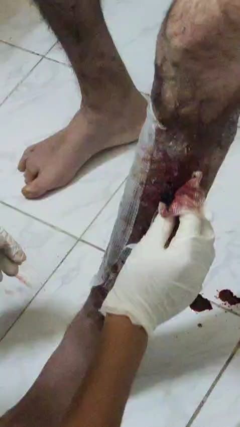 "بيموت بالبطيء".. محمد شوقي يُصارع مرضًا مناعيًا نادرًا ويحتاج لعلاج