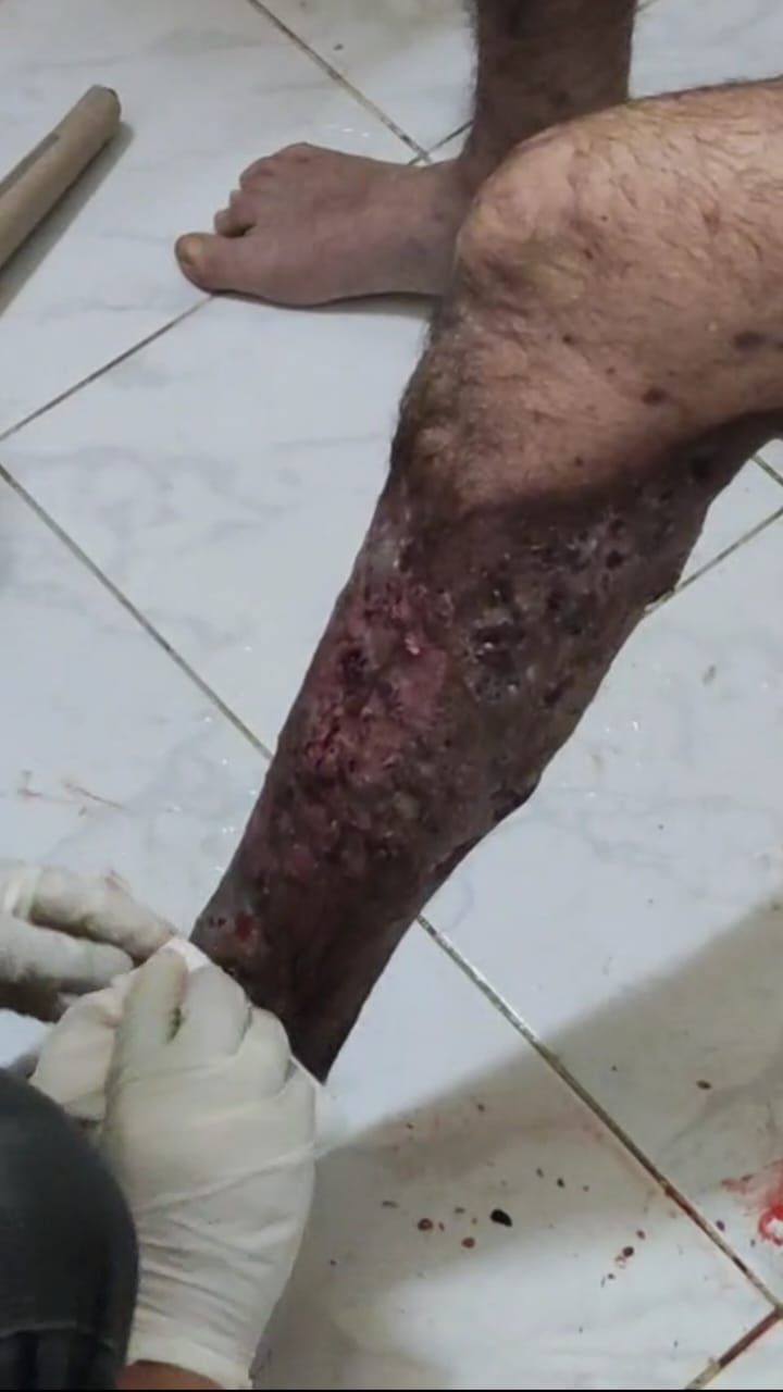 "بيموت بالبطيء".. محمد شوقي يُصارع مرضًا مناعيًا نادرًا ويحتاج لعلاج