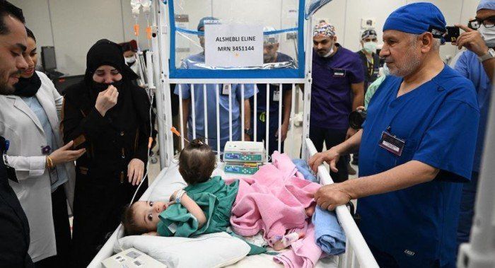 إنجاز طبي سعودي عالمي.. نجاح عملية فصل التوأم السوري “سيلين وإيلين” بعد جراحة دقيقة استمرت 8 ساعات