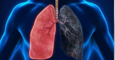 كيف تختلف أعراض سرطان الرئة عند النساء والرجال.. 4 طرق للوقاية