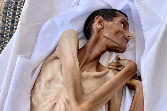 شاب فلسطينى يموت جوعا فى مستشفى الشفاء الطبى بغزة.. صورة