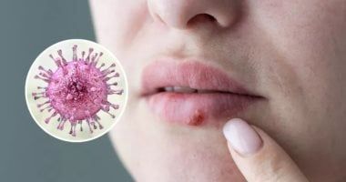 هل تعانى من تقرحات الفم المزعجة.. علاجات طبيعية لتخفيفها