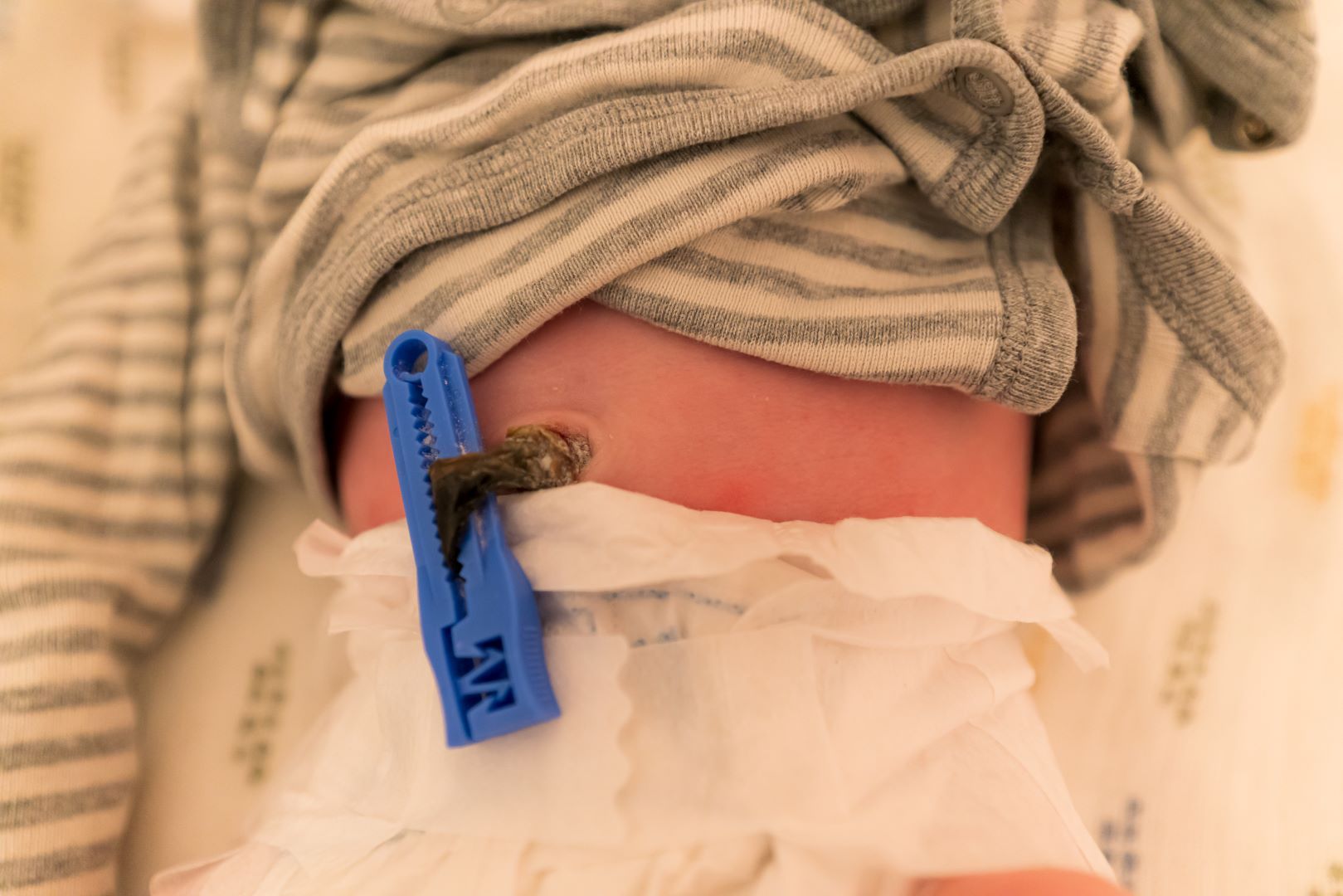 تجربتي في العناية بسرة مولودي عندما تأخر سقوطها