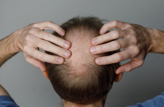 أمل جديد الصلع.. علاج ثوري يعيد الشعر