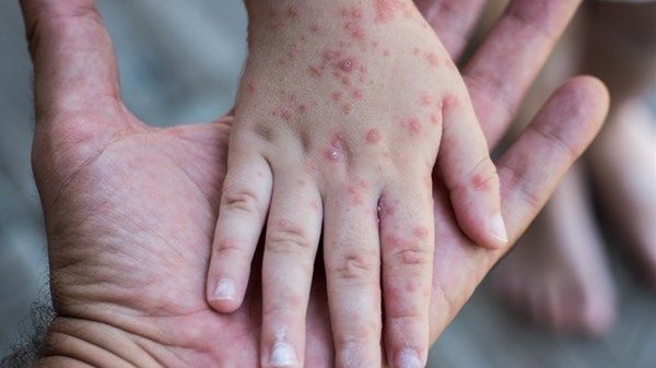 تفشي الحصبة في الأميركيتين يدفع "باهو" لإطلاق إنذار وبائي