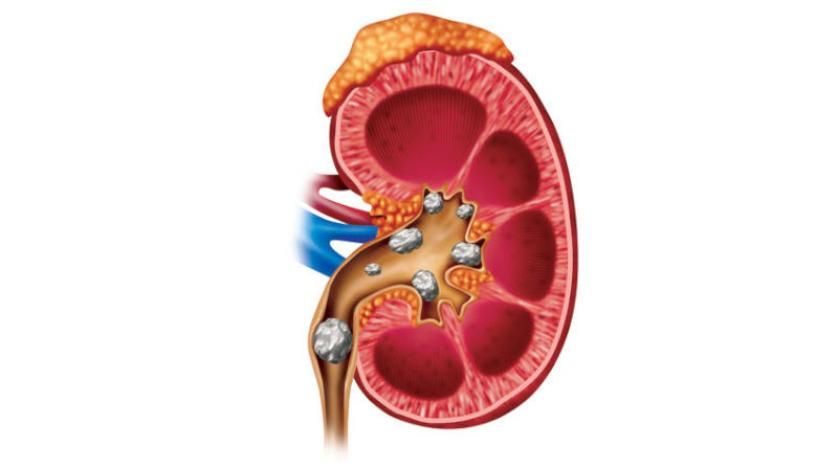 دراسة تفجر مفاجأة عن السبب الحقيقي لتكون حصوات الكلى