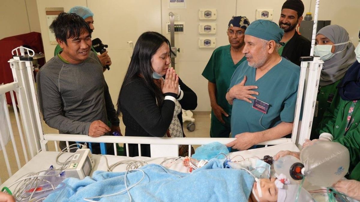 في إنجاز طبي جديد.. نجاح عملية فصل التوأم الملتصق الفلبيني (أوليفيا وجيانا) بعد 6 ساعات