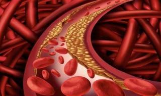 كيف يؤثر ارتفاع الكوليسترول الضار على ضغط الدم؟