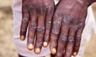 السويد ترصد أول إصابة بالسلالة الجديدة من جدري القردة خارج أفريقيا