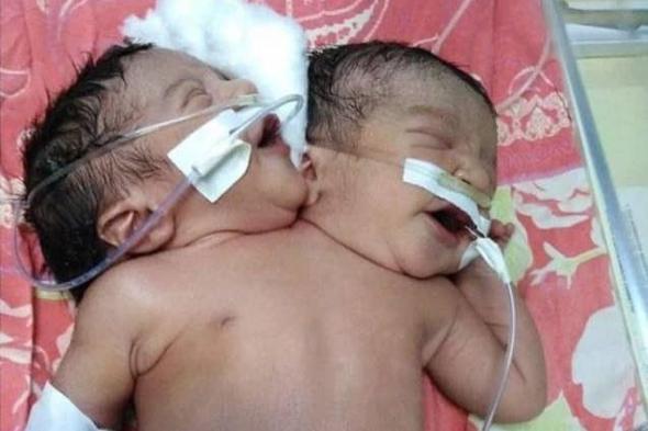 بالصور: حالة ولادة نادرة في مصر.. طفل برأسين وقلب واحد وعمودين فقريين