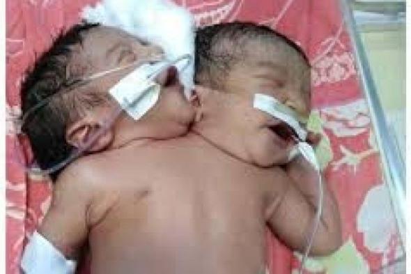 تراند اليوم : سيدة مصرية تنجب طفلاً بقلب واحد ورأسين