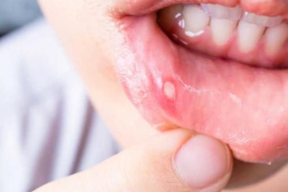 قرح الفم.. الأعراض والأسباب وطرق العلاج