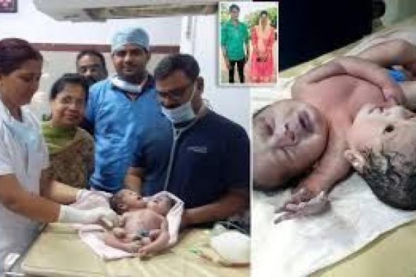 شاهد حالة نادرة في الهند.. ولادة طفل برأسين و3 أذرع لا يمكن الفصل بينهما