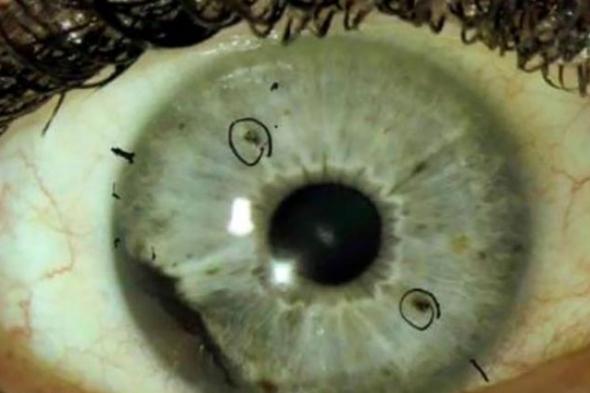 الفطر الأسود في العين.. تعرف على أعراض الإصابة به؟