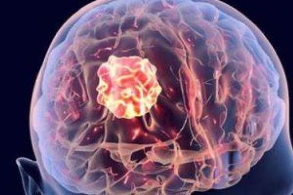 ما هي علامات سرطان الدماغ؟..تقرير يوضح