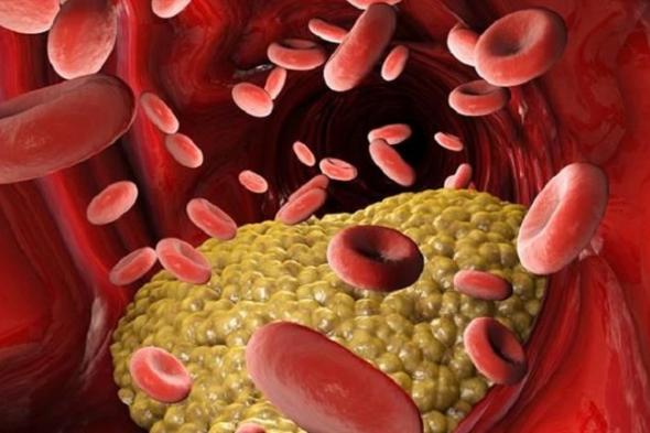 5 أعراض تكشف ارتفاع الكوليسترول في الدم