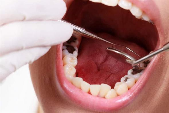 كيف يؤثر تسوس الأسنان على صحة قلبك؟