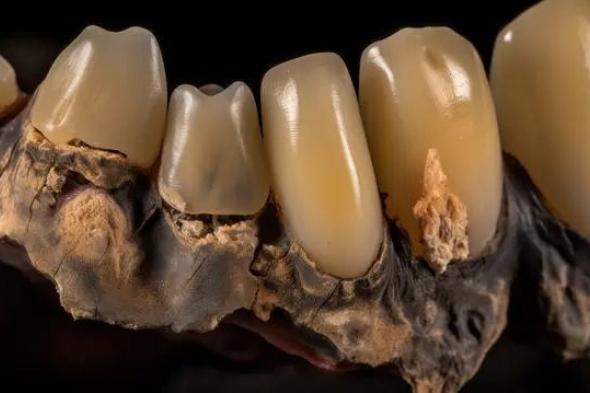 الامارات | العثور على أسنان بشرية متسوّسة عمرها 4000 عام