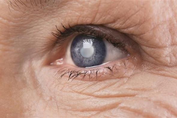مرض "المياه الزرقاء".. هل يسبب العمى؟