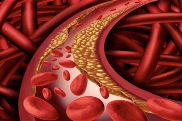 كيف يؤثر ارتفاع الكوليسترول الضار على ضغط الدم؟
