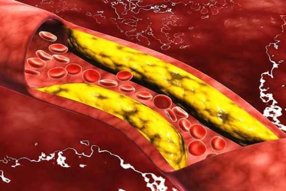 علامة تكشف ارتفاع الكوليسترول بالدم… وهذه طرق علاجه