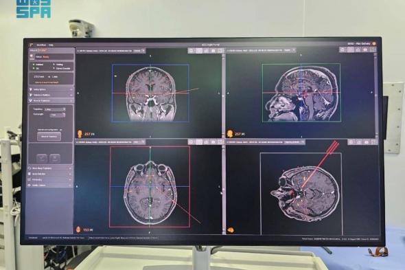 تطبيق تقنية الجراحة الفراغية للدماغ في العلوم العصبية