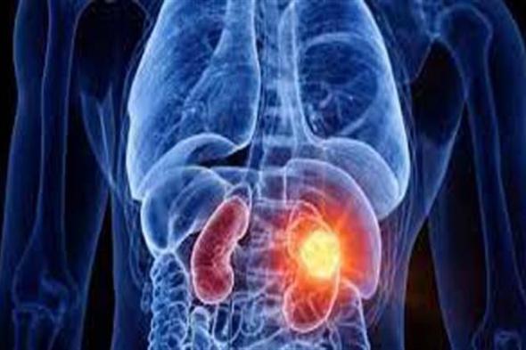 علامات إذا ظهرت عليك تدل على الإصابة بسرطان الكلى