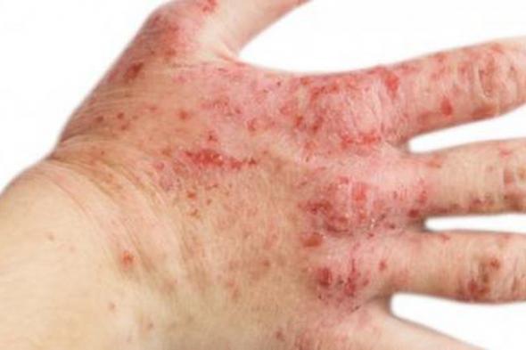 هل يوجد علاج نهائي للإكزيما؟.. 4 طرق للسيطرة عليها وتخفيف آثارها